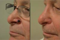 55-64 year old man treated with Mole Removal/ Skin Cancer removal and reconstruction