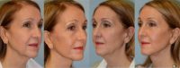 55-65 year old woman SMAS facelift