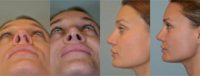 25-34 year old woman Revision Rhinoplasty