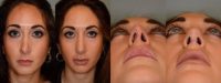 32 year old female after revision rhinoplasty
