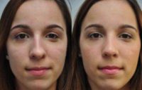 Rhinoplasty for a crooked nose, uneven nostrils, and a nasal hump.