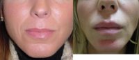 35-44 year old woman treated with Lip Implants