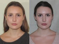 25-34 year old woman treated with Septoplasty
