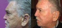 65-74 year old man treated with Laser Surgery