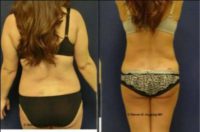 Woman treated with Laser Liposuction