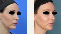 Dr. Howard Webster, MBBS (Hons), FRACS, Melbourne Plastic Surgeon - 36 Year Old Woman Treated With Rhinoplasty