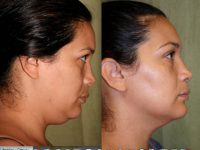 Liposculpture of the neck/chin