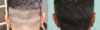 35-44 year old man treated with ARTAS Robotic Hair Transplant - Donor Area