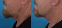 55-64 year old man treated with Neck Lift