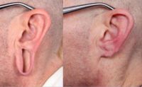 25-34 year old man treated with Ear Lobe Surgery