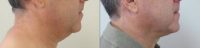 Male liposuction to define lower face and jawline