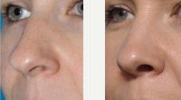 Dr. Kian Karimi, MD, FACS, Los Angeles Facial Plastic Surgeon - 3 Year Rhinoplasty Result -- A Nose For Life