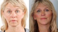 35-44 year old woman treated with Facelift