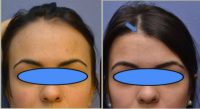 25-34 year old woman treated with Forehead Reduction