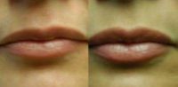 35-44 year old woman treated with Restylane for lip augmentation.