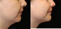25-34 year old woman treated with Injectable Fillers to augment chin