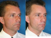 Dr. Michael Fozo, MD, FACS, Detroit Facial Plastic Surgeon - Middle Aged Man With Rhinoplasty Nose Surgery