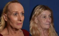 55-64 year old woman treated with MTF Facial Feminization Surgery