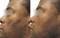 35-44 year old man treated with IPL