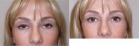 35-44 year old woman treated with Eyelid Surgery
