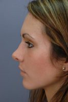 Dr. P. Daniel Ward, MD, Salt Lake City Board Certified Facial Plastic Surgeon Reshaping Of The Nose