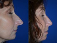 45-54 year old woman treated with Rhinoplasty
