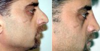 Dr. Philip Solomon, MD, FRCS, Toronto Facial Plastic Surgeon - Septorhinoplasty