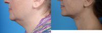 41 year old women, Face and Neck Liposuction