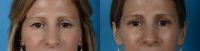 Woman treated with Upper Eyelid Surgery / Blepharoplasty