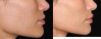 38 y/o woman - lip augmentation with fillers