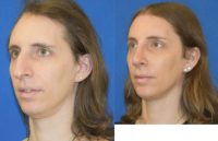 25-34 year old woman treated with MTF Facial Feminization Surgery