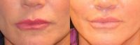 45-54 year old woman treated with Lip Lift