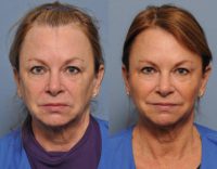 Juvederm to midface