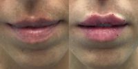 Non-surgical Lip Augmentation