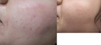 18-24 year old woman treated with Intracel for Acne Scarring