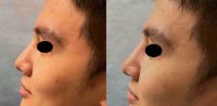 18-24 year old male underwent a Non Surgical Nose Job with Restylane