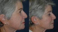 65-74 year old woman treated with Bellafill