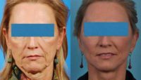 45-54 year old woman treated with Sculptra