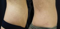 45-54 year old woman treated with Smart Lipo