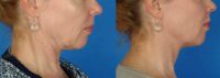 56 year old female interested in nonsurgical facial rejuvenation, Ulthera.
