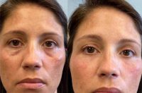 35-44 year old woman treated with Dark Circles Under Eye Treatment