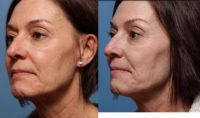 55-64 year old woman treated with Sculptra