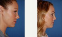 Dr. William Portuese, MD, Seattle Facial Plastic Surgeon - 33 Year Old Woman Treated With Rhinoplasty