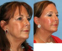 Facelift, Browlift, Lower Blepharoplasty and Liposculpture