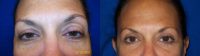 Eyelid Lift- Blepharoplasty