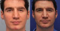 Facial Fat Transfer for Scar Revision