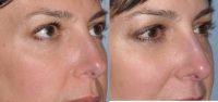 Facial filler to lower eyelid and cheek