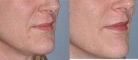 Facial Filler to Lower Face