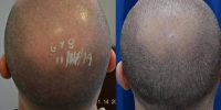 Fat Grafting to Scalp for Hair Loss