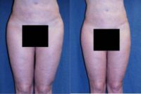 Liposuction of Abdomen, Hips, Flanks and Knees
